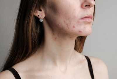 Acne Clearing v2